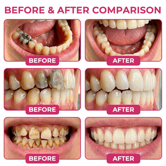 TopSpire® DenPerm Cavity-Repair Natural Enamel Filling Gel